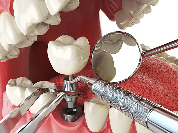 Best Emergency Tooth Extraction in Sherwood, OH